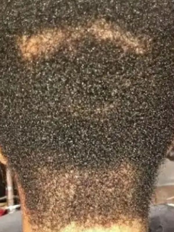 After — Hair loss recovery progress